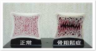 骨粗鬆症とは?